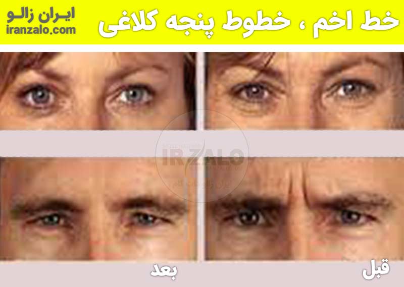 خط اخم و خطوط پنجه کلاغی