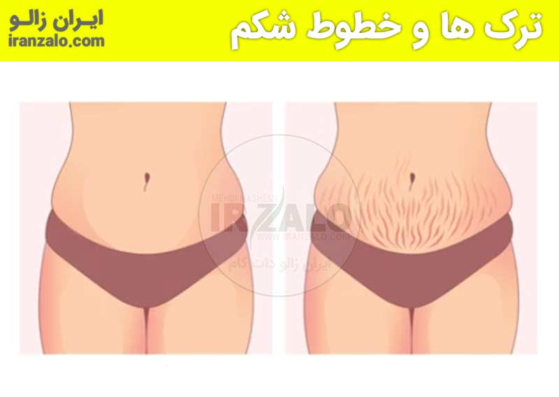 قبل و بعد استفاده از روغن خراطین برای شکم و پهلوها 1