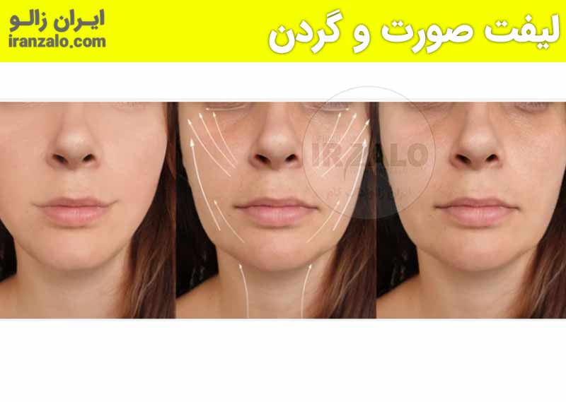 عکس قبل و بعد استفاده از روغن خراطین برای پوست صورت و لیفت (1)