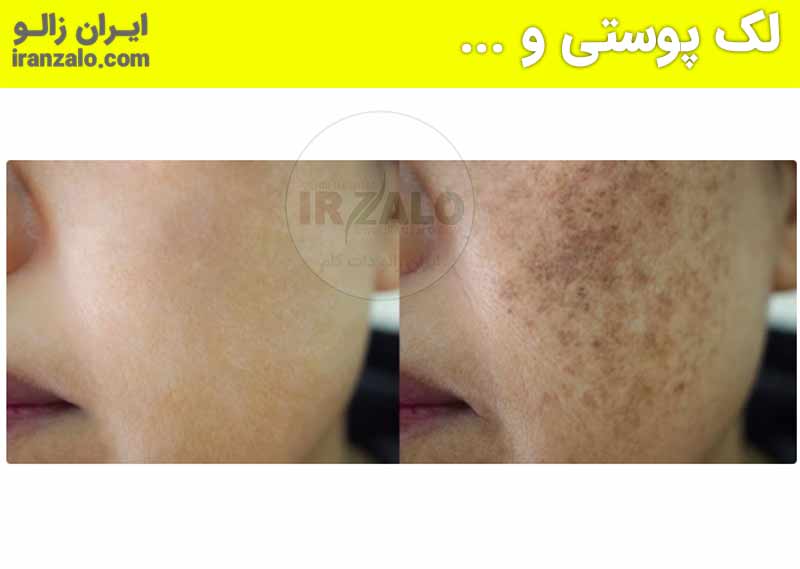 عکس قبل و بعد استفاده از روغن خراطین برای پوست صورت