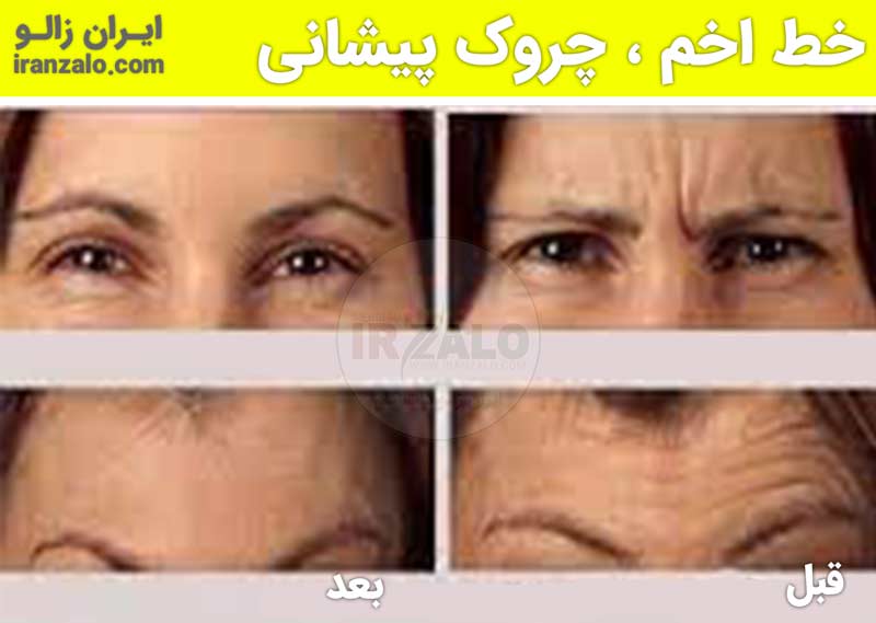 عکس قبل و بعد خطوط اخم و پیشانی در استفاده از روغن خراطین