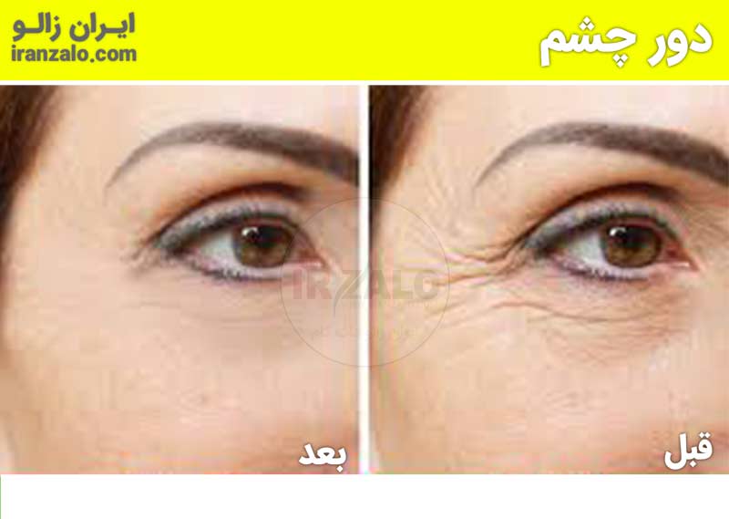 کدام روغنها بهترین حجم دهنده طبیعی هستند؟ رازهای حجمدهی طبیعی با روغنهای گیاهی! ✨ 3 عکس قبل و بعد رفع خطوط دور چشم با روغن خراطین و زالو (4)