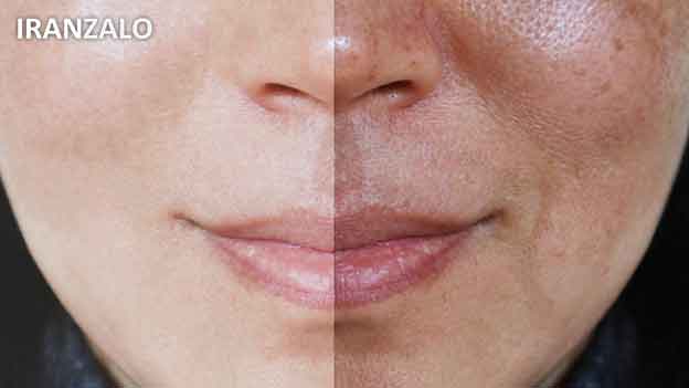 5 دلیلی که روغن خراطین تبدیل به پرفروشترین روغن طبیعی شده 4 رفع لک و تیرگی صورت با روغن خراطین و زالو