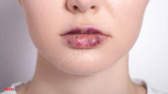 حجم دهنده های فوری لب: بهترین روشهای بدون تزریق برای داشتن لبهایی پر و جذاب! 💋 5 برای ماساژ و ورزش لب 7